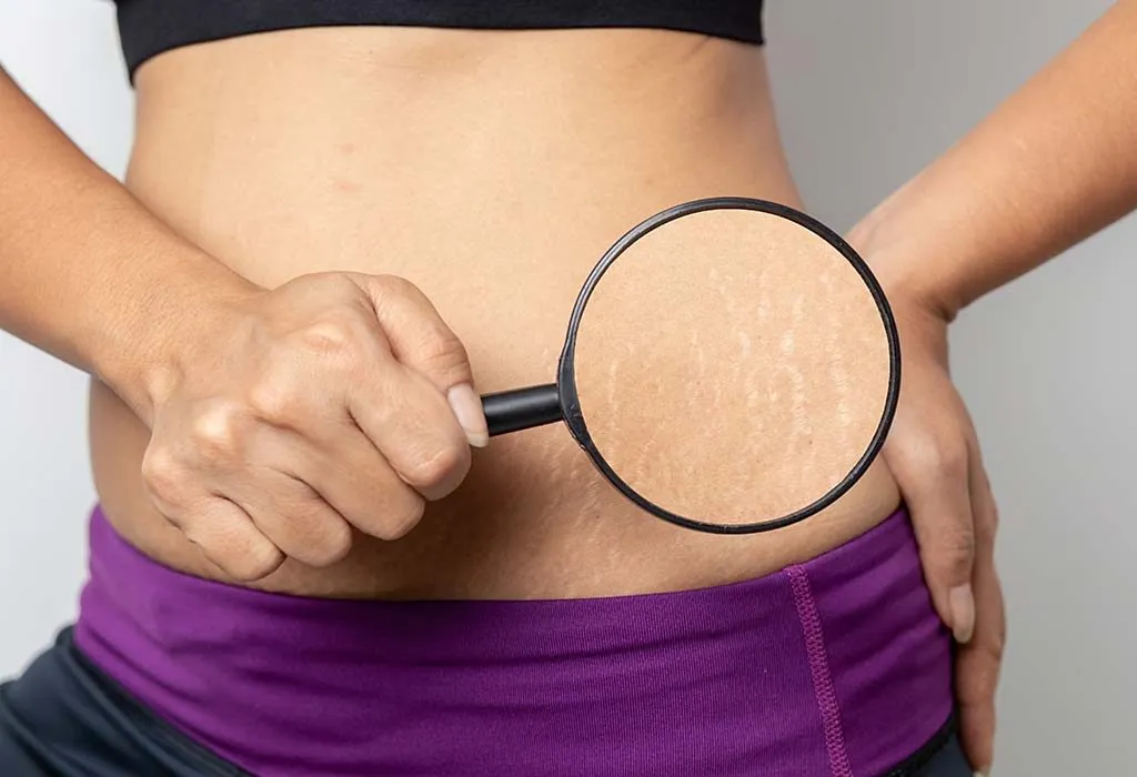 The Truth About Stretch Marks- 4 Signs You May Get Them While Pregnant