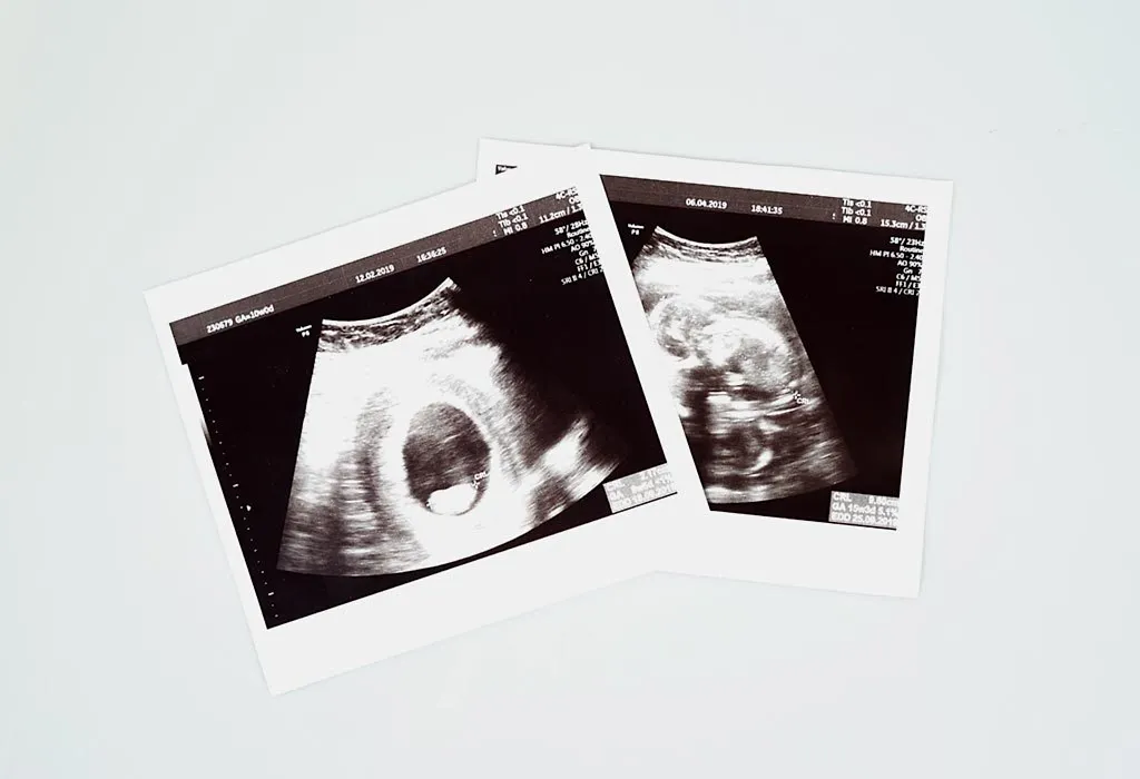 Semi-Scientific Ways To Tell The Gender Of A Baby