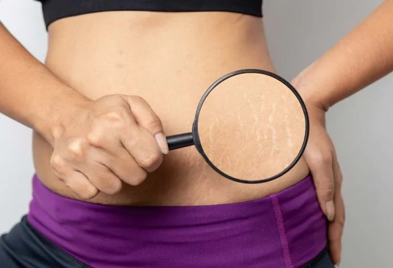 Pregnancy Stretch Marks are a Reminder of a Beautiful Journey
