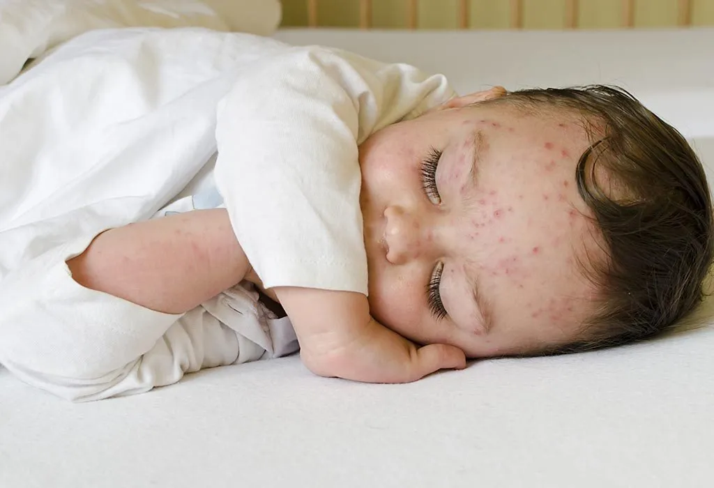 Viral Rashes in Babies – Types, Symptoms and Treatment