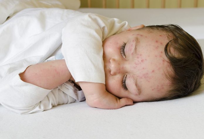 Viral Rashes in Babies - Types, Symptoms and Treatment