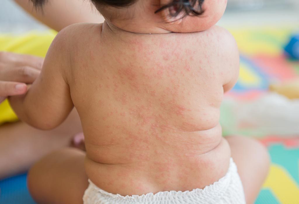 rashes in children with no fever