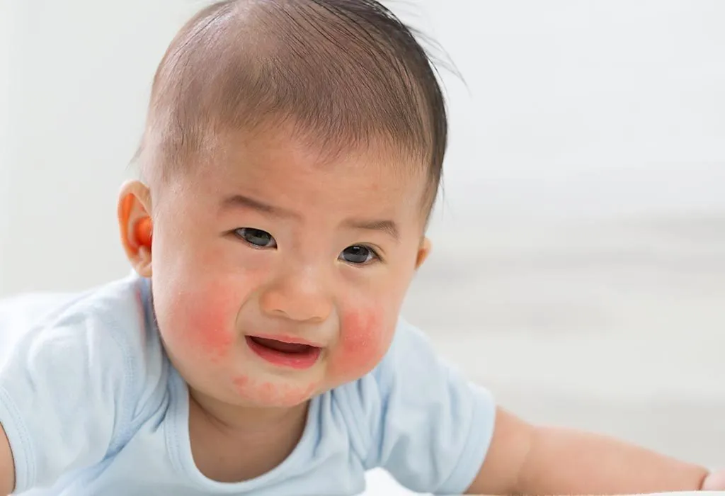 baby with a skin rash