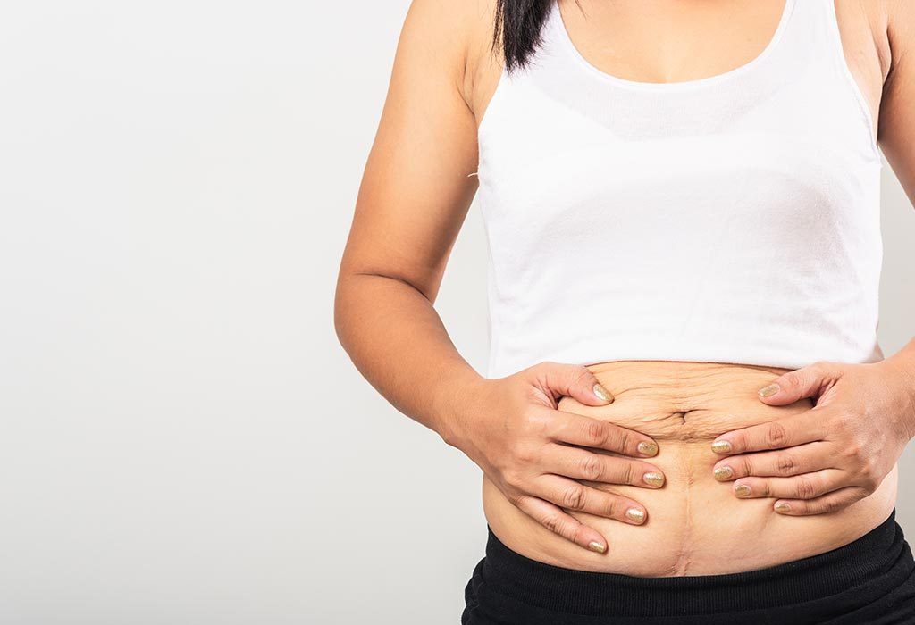Mother’s Apron Belly After Pregnancy – Causes and Remedies
