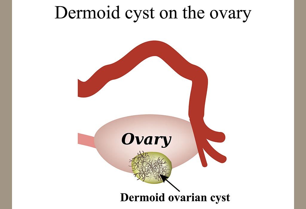 Ovarian dermoid cyst