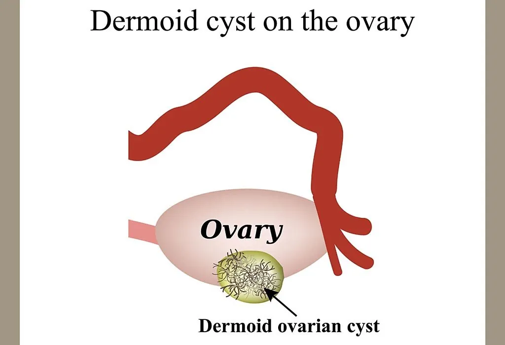Ovarian dermoid cyst