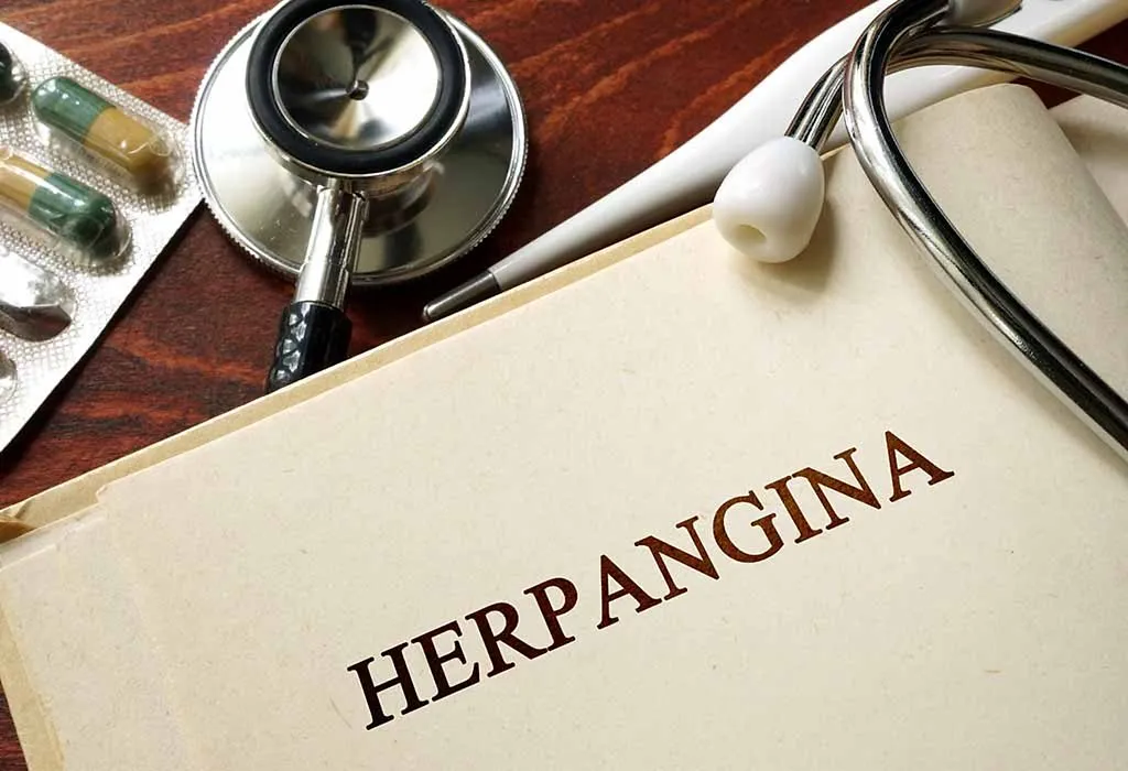 How Can Herpangina Be Treated