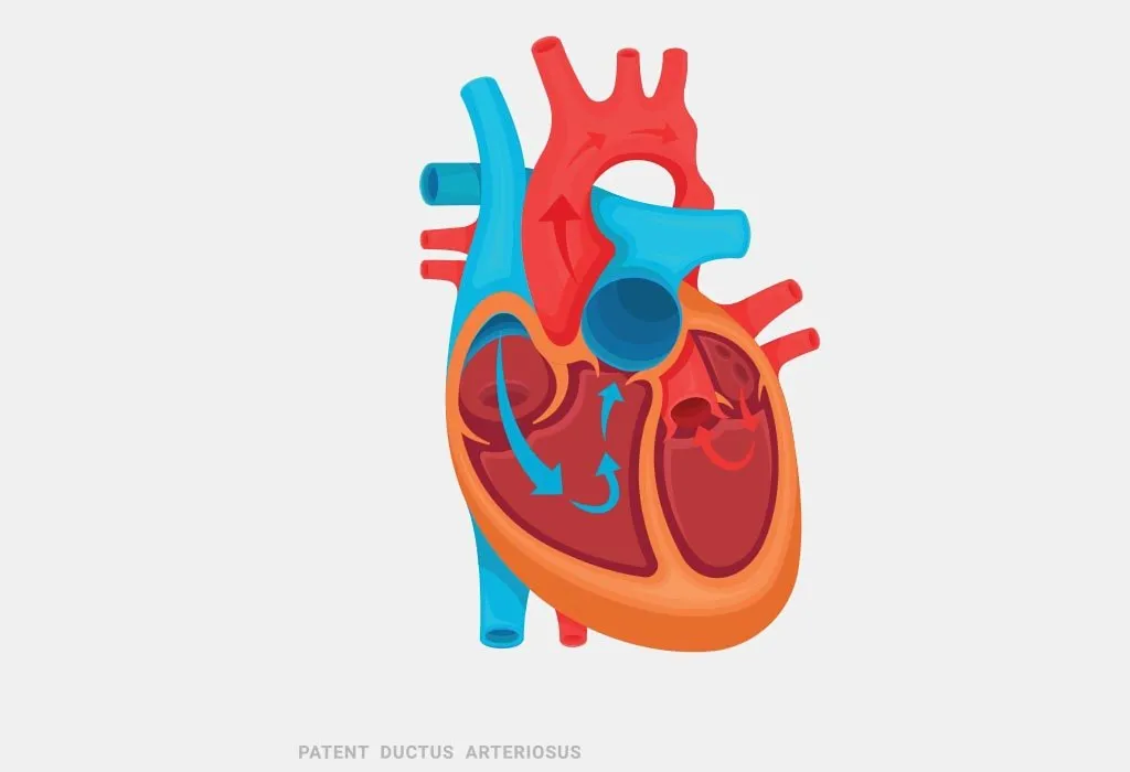 patent-ductus-arteriosus-reasons-signs-treatment