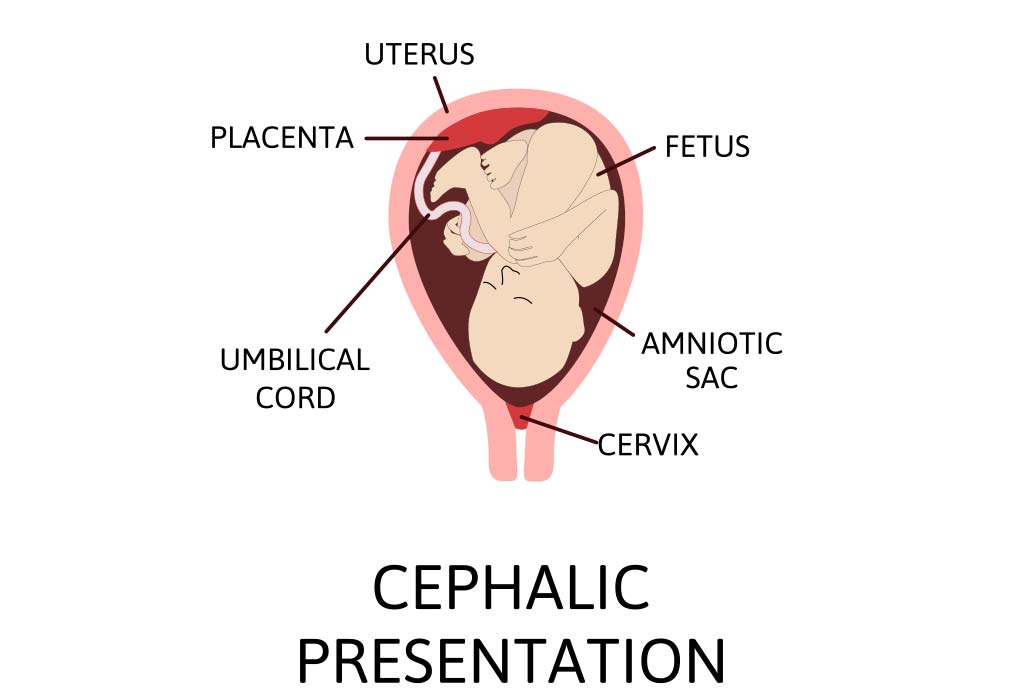 presentation is cephalic with spine to maternal left