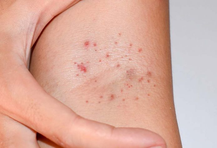 petechiae on a child's arm