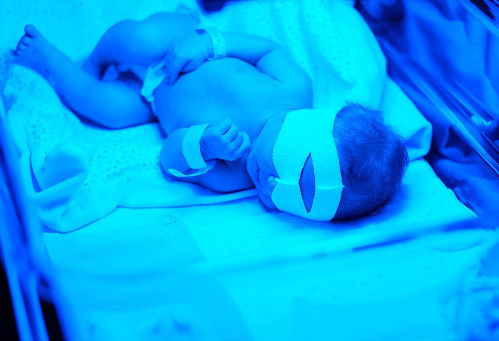 baby receiving phototherapy for jaundice