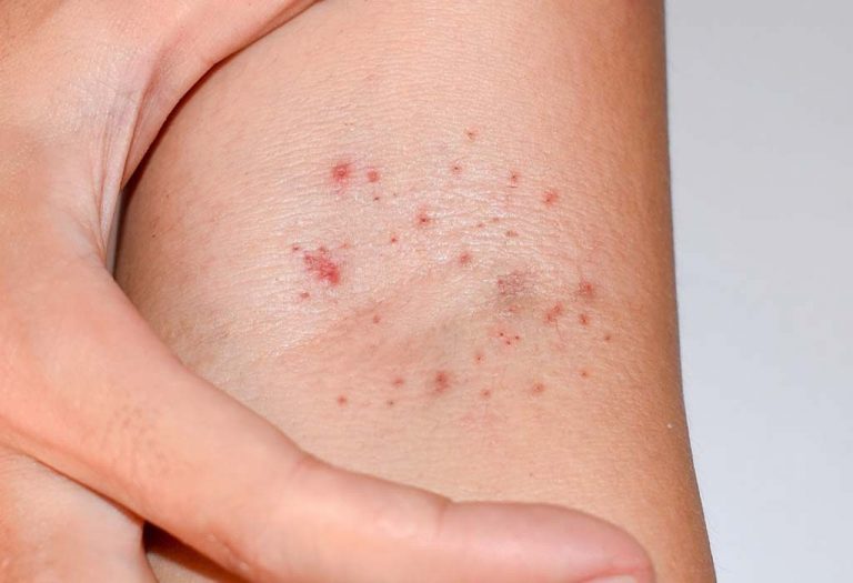Petechiae In Babies - Causes, Signs and Treatment