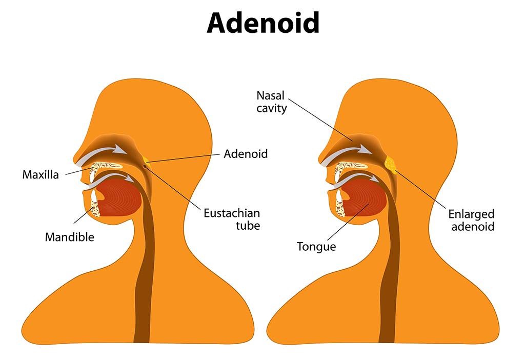 Enlarged Adenoids in Kids: Reasons, Signs & Treatment