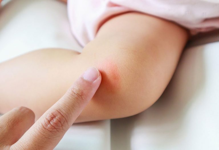 Folliculitis in Babies and Kids - Causes, Symptoms, and Treatment