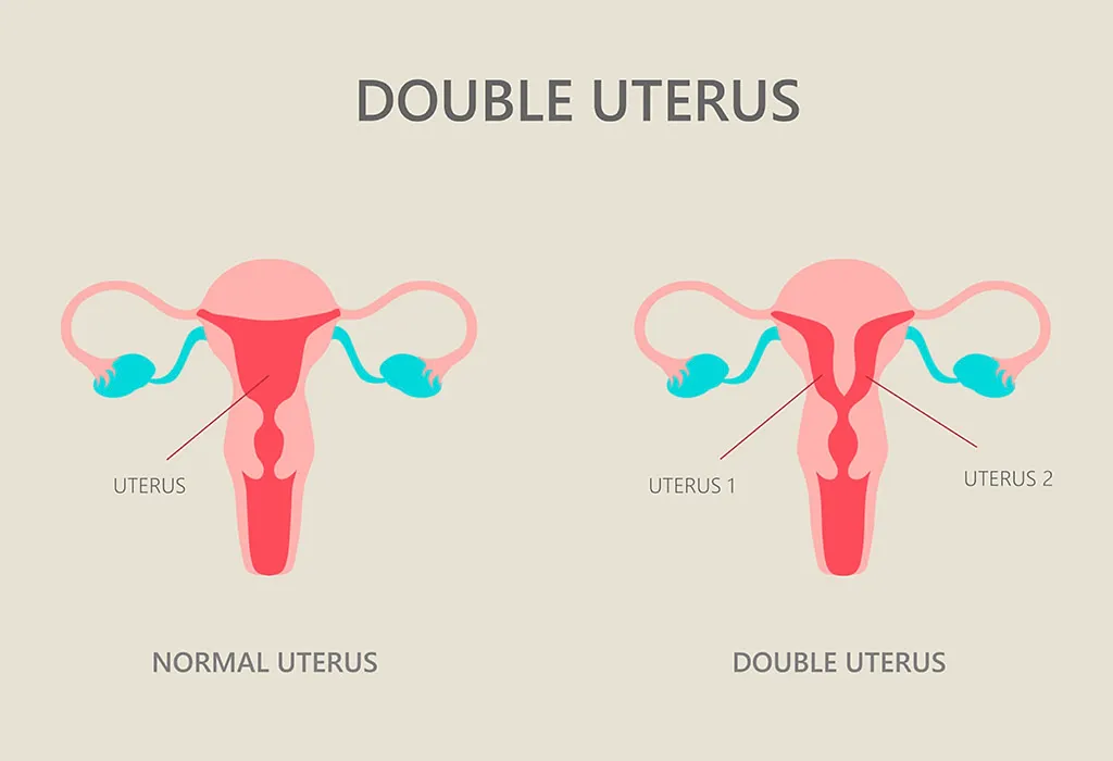 Double uterus in pregnancy