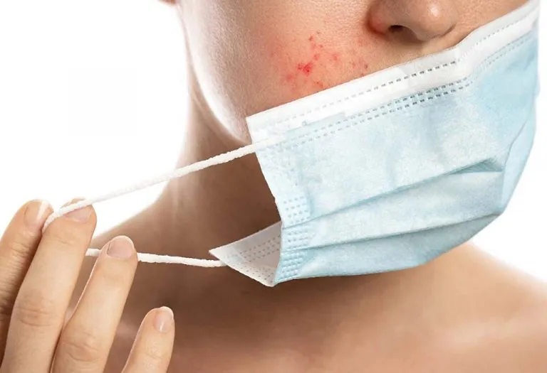 What Is Maskne And How To Get Rid of It