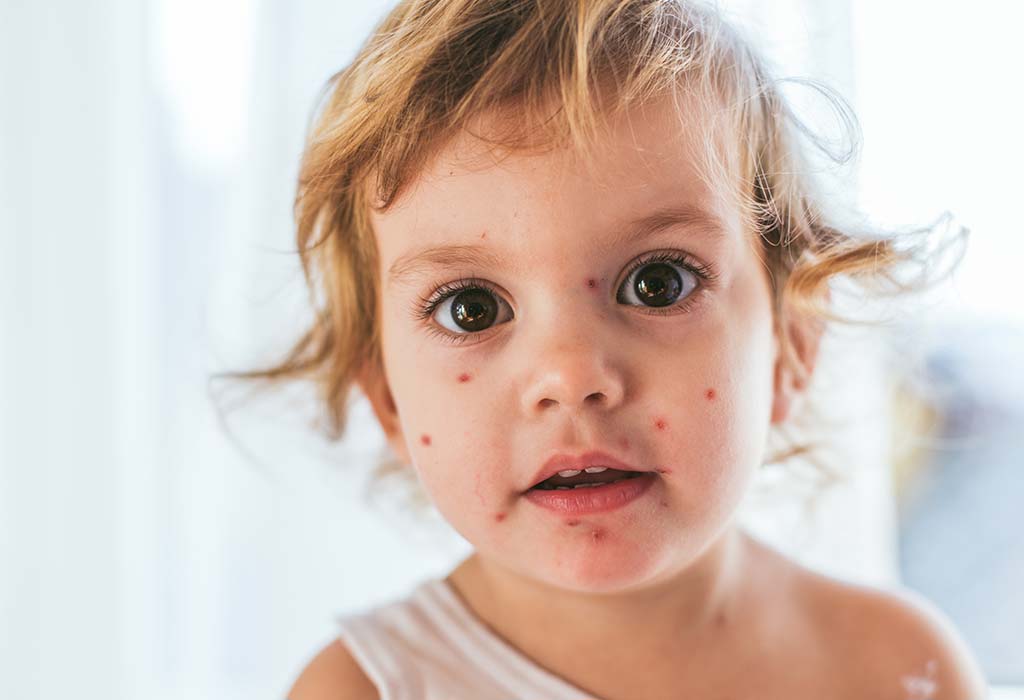 What Is Chickenpox?