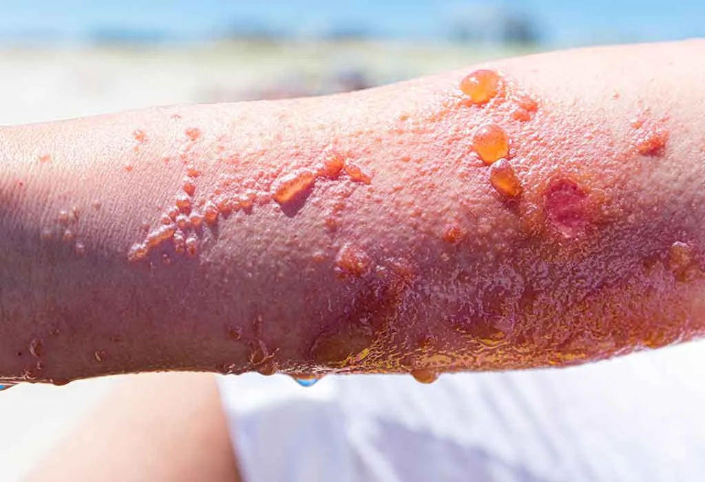 How to treat poison ivy rash; how to destroy poison ivy plants