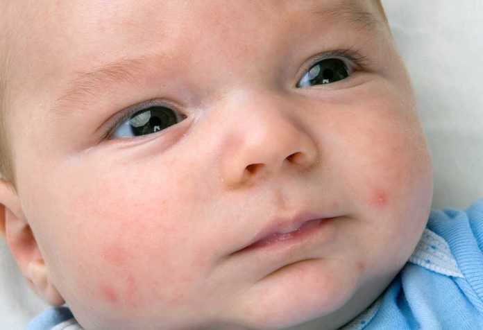 New Mothers! Don’t Worry If Your Newborn Has Acne