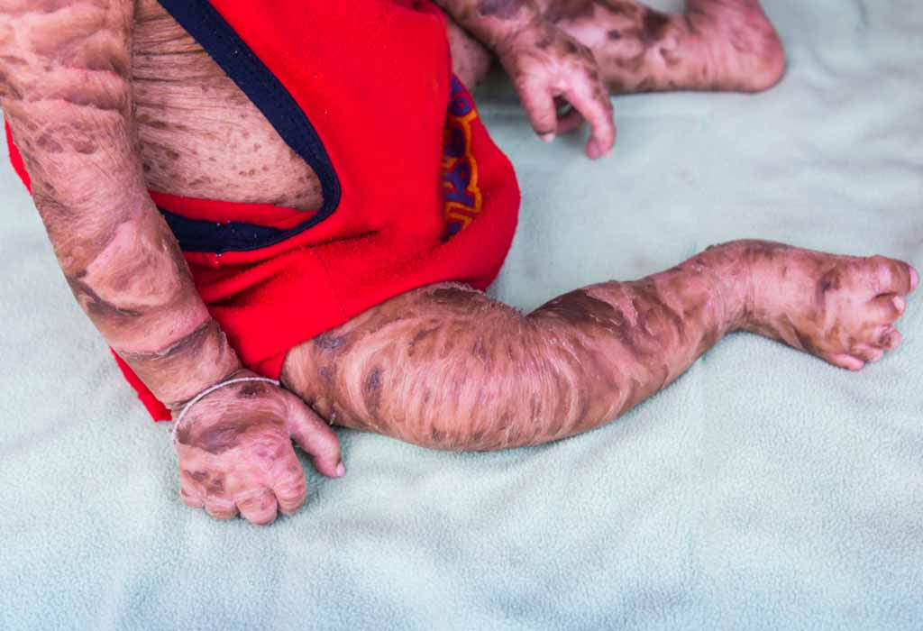 Harlequin Ichthyosis Complications