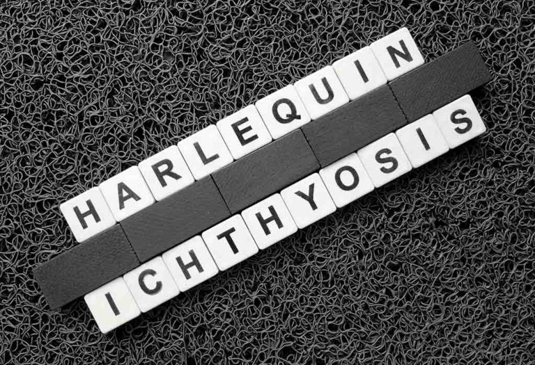 Harlequin Ichthyosis in Infants – Causes, Symptoms, Diagnosis, and Treatment