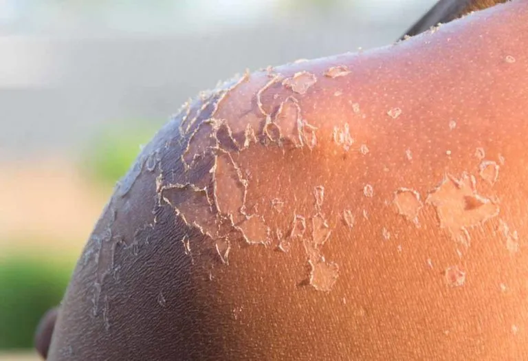 Sunburn Peeling – Causes, Symptoms and Prevention