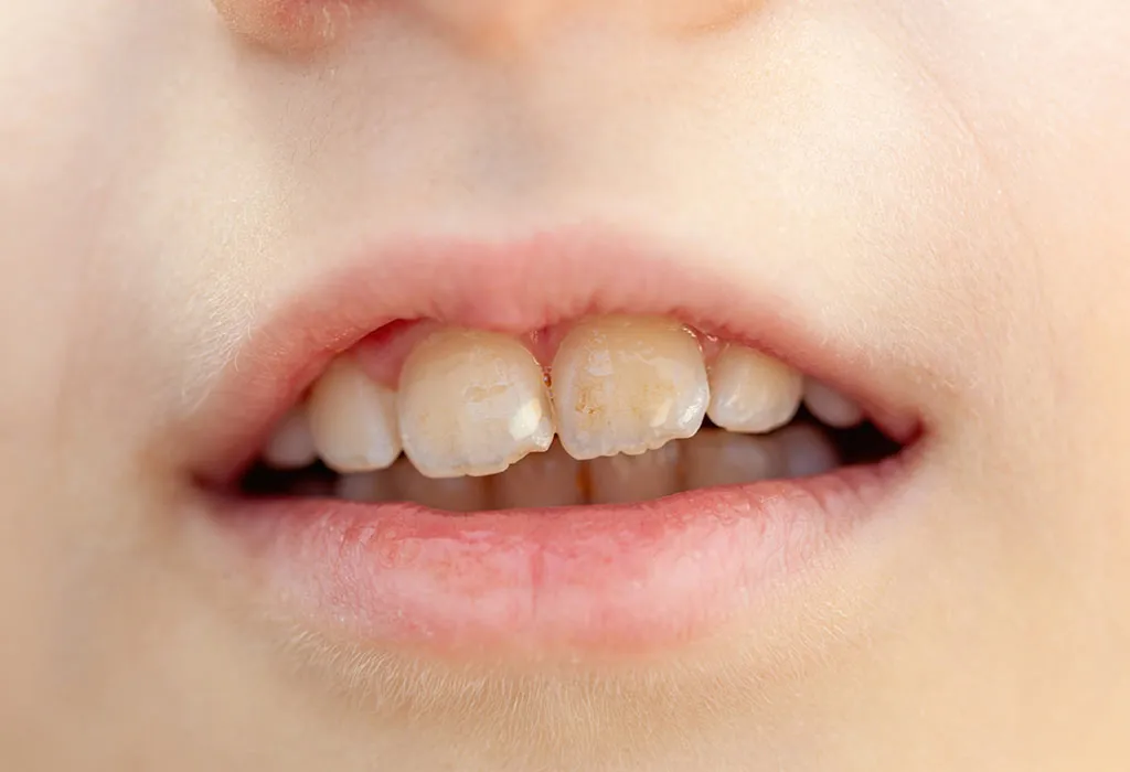 May Cause Tooth Enamel Erosion