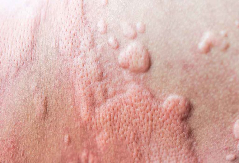 what-is-puppp-common-pregnancy-rash-explained-the-advertiser