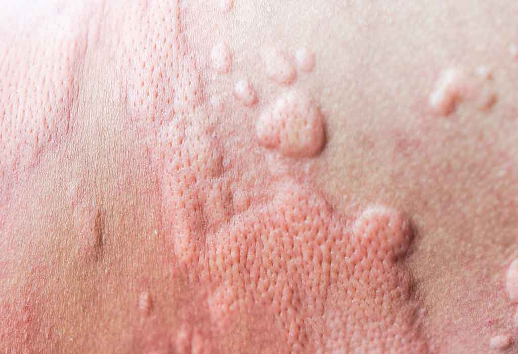 Signs and Symptoms of PUPPP Rash