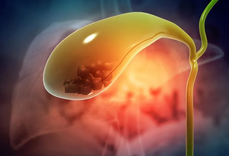 Gallstones in Pregnancy - Symptoms, Causes, Treatment & Prevention