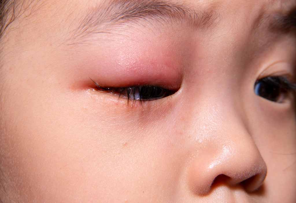 Stye in Child's Eye: Types, Causes, Signs, and Treatment