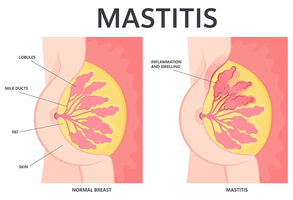 Mastitis
