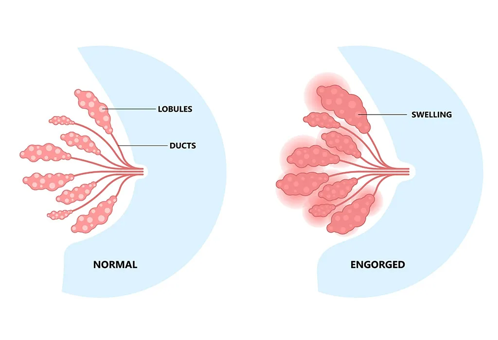 Engorgement of Breasts
