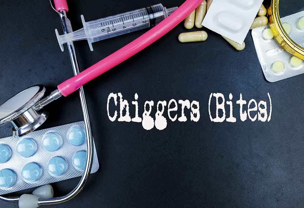 Treatment for Chigger Bites in Kids