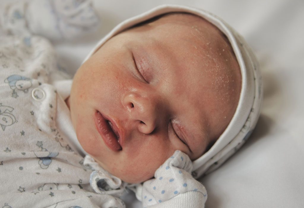 बाळांमधील क्रेडल कॅप वर उपचार करण्यासाठी १५ सोपे आणि परिणामकारक घरगुती उपाय