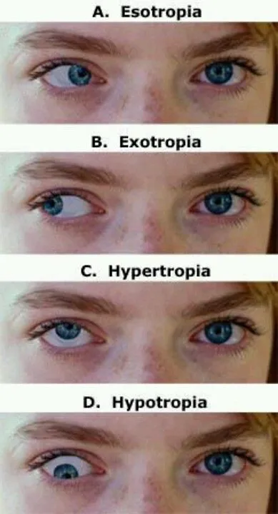 Types of Squint