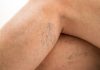 गर्भावस्था के दौरान वैरिकोज वेन्स की समस्या Pregnancy ke dauran varicose veins ki samasya