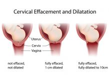 प्रसव के दौरान सर्विक्स का खुलना – Delivery Ke Dauran Cervix Ka Khulna Delivery Ke Dauran Cervix Ka Khulna