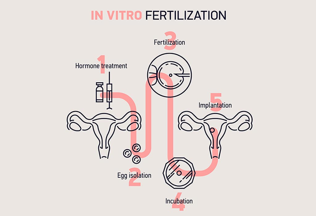 In Vitro Fertilisation