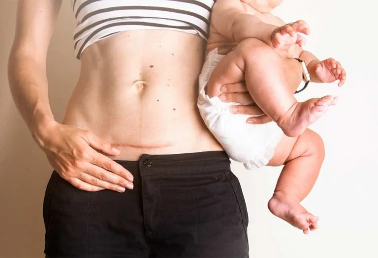 10 Things You Should Know About C-Sections