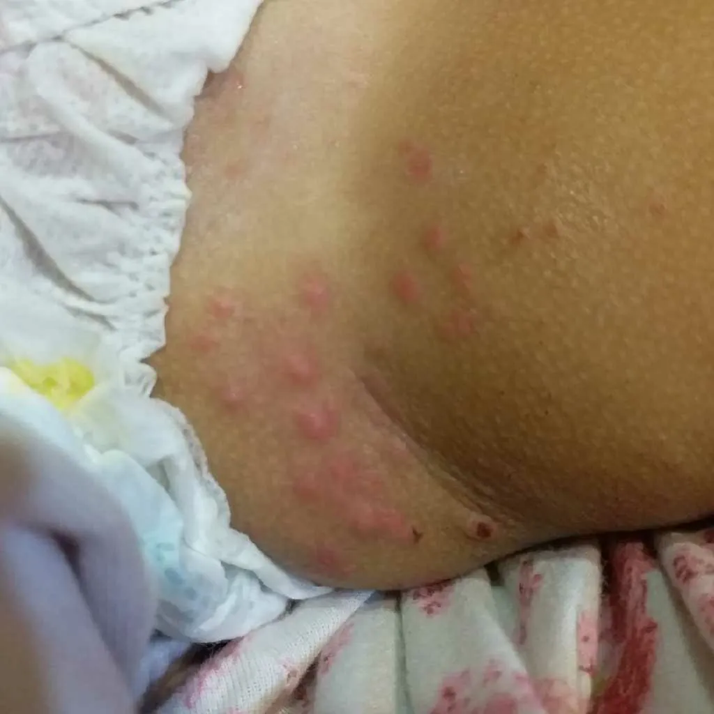 Pastu Rash #AskTheExpert Hi Doc. My 3.5 week old has papulopustular rashes on the ...
