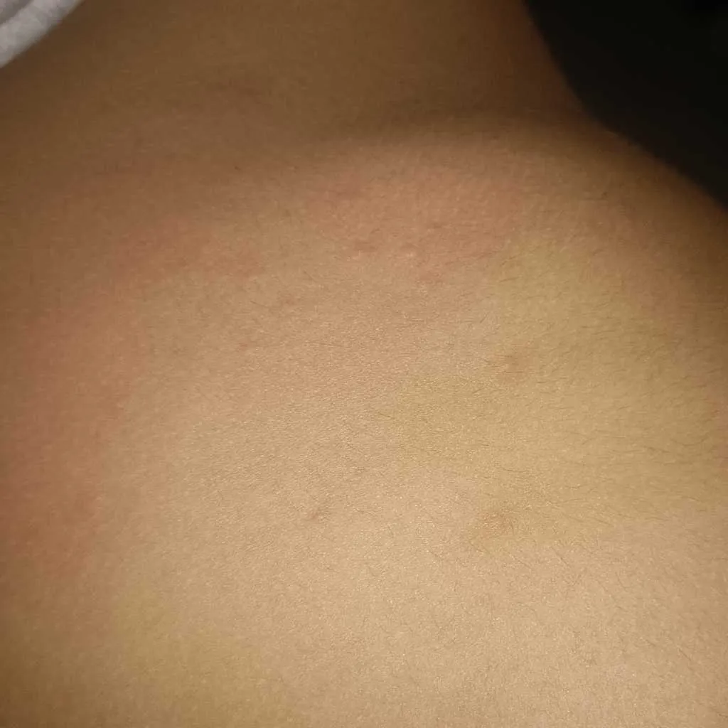 Lumpy Rash After Eating #asktheexperts my son got red rashes on stomach after eating some ...