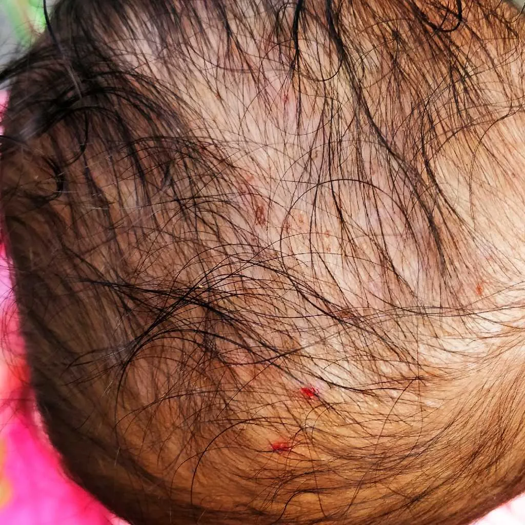 My baby is getting little itchy small bumps on her scalp causing her  irritation and every day one or two are breaking with blood. image is  attached and please help – FirstCry