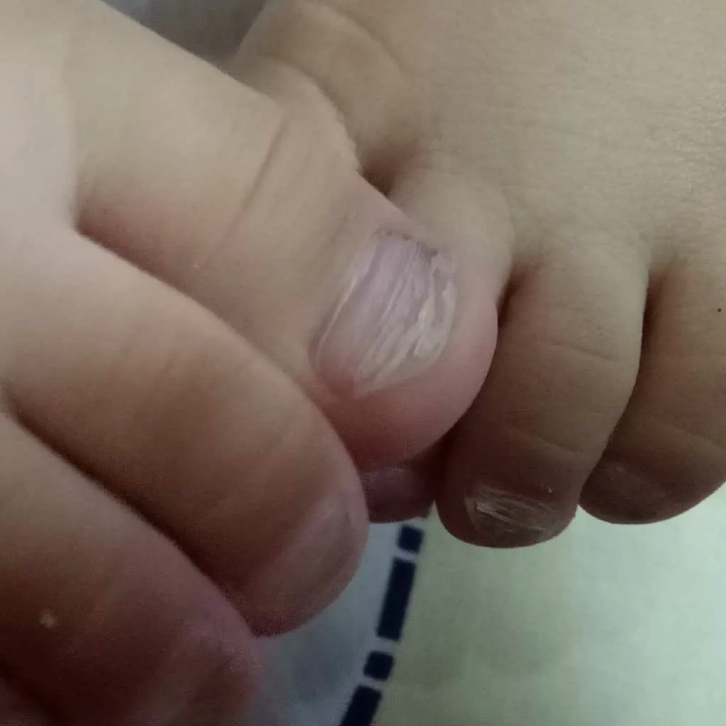 my baby's nails are broken and layered worried about this.. – FirstCry  Parenting