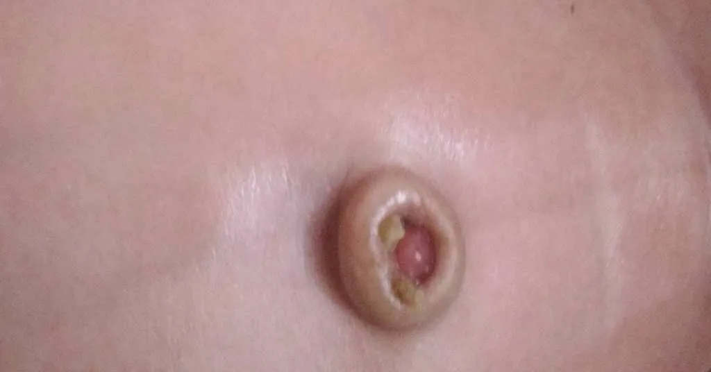 AskTheExpert my daughter is 2 months old now. belly button is not dried/healed yet. sometimes puss oozes out it. we can see red flesh inside it. please refer attached