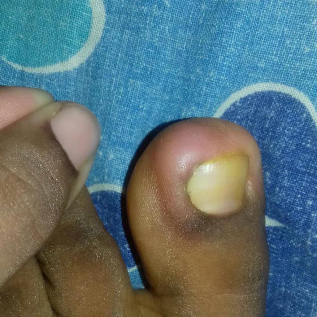 Hi Doctor Please look into the below attachment picture. My toe nail was  filled with pus. i have already used Augmentin antibiotic as suggested by  local pediatrician but still not cured..could you