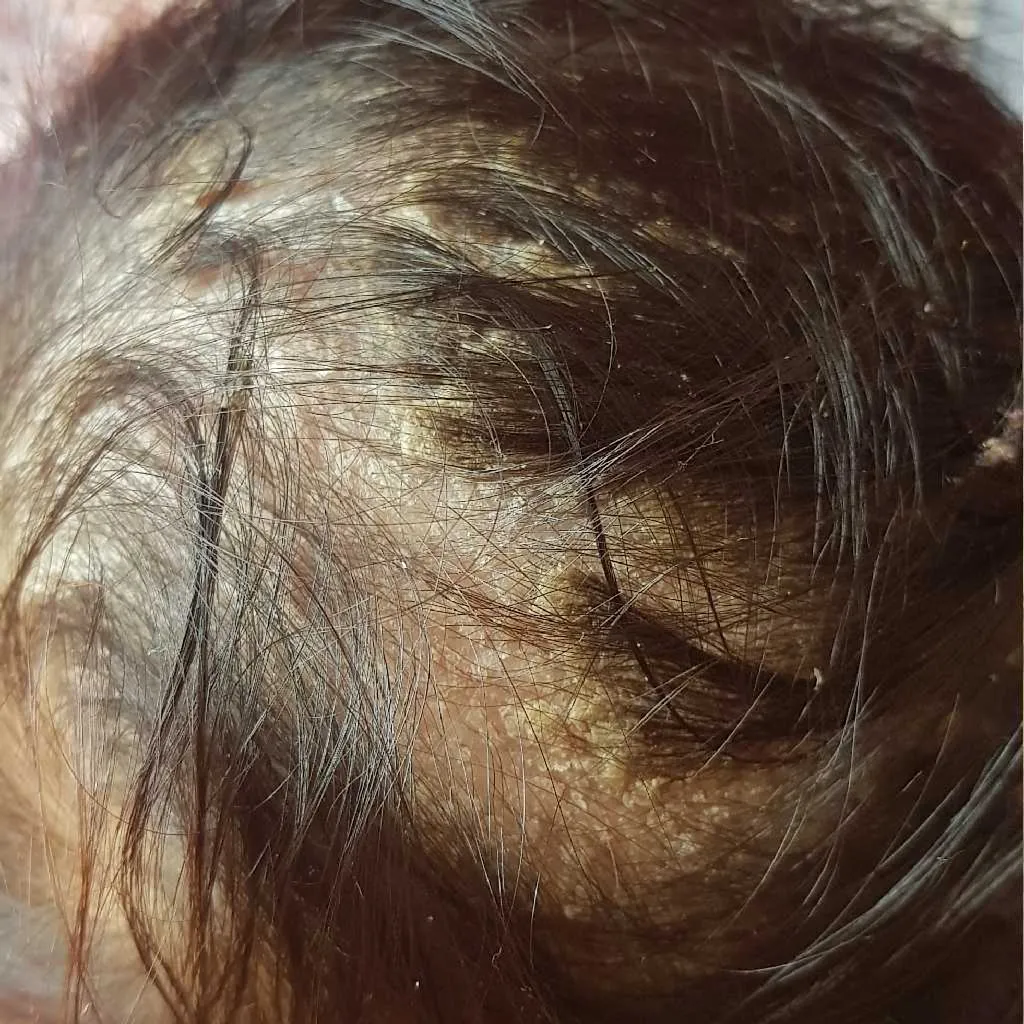 My baby's scalp is Crusting and white or yellow scales are seen which are  resulting in hair loss. Some bald patches are generated due to this. Is  this normal? Will this go