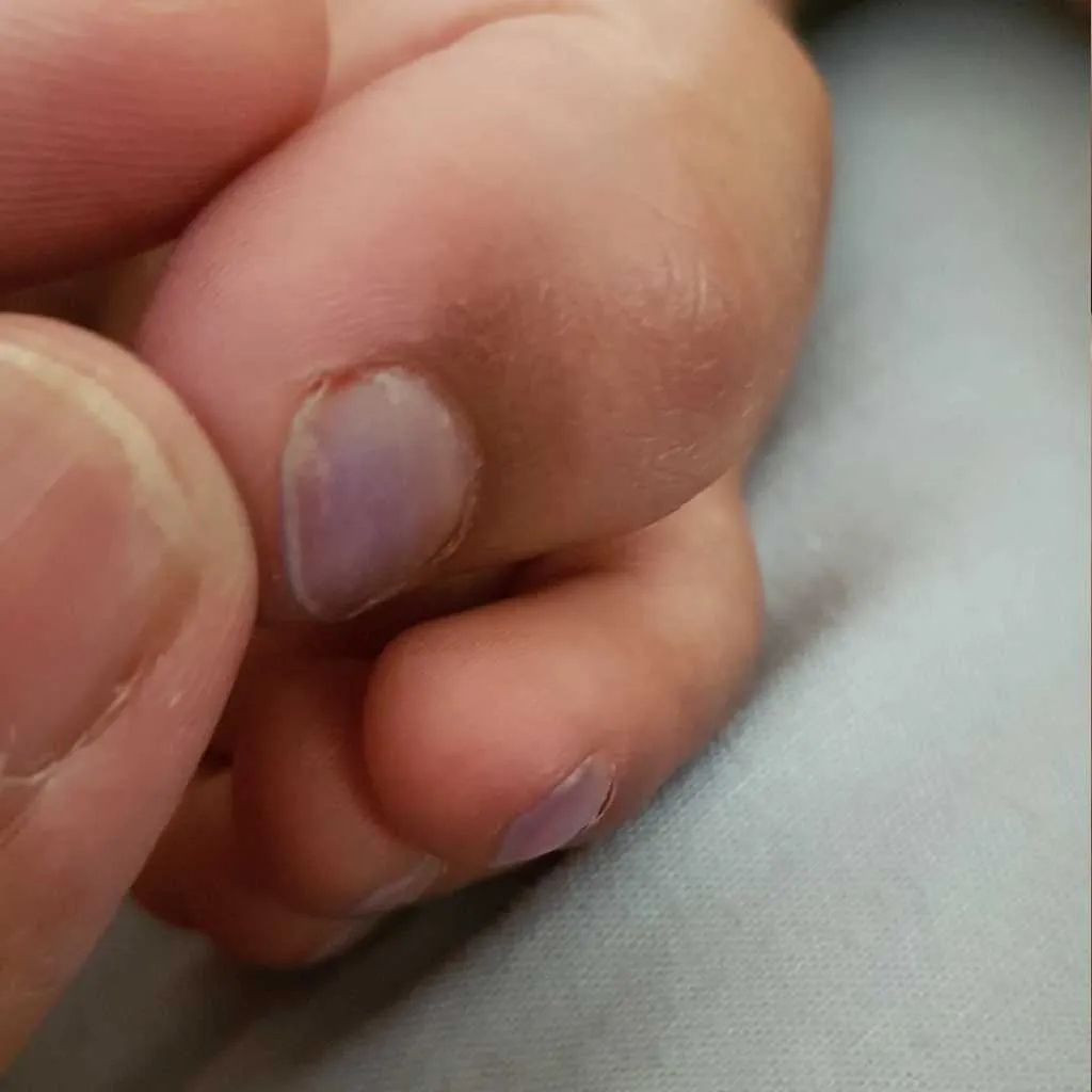 Hello, my son who is one year and 10 months old has got blue/purple color  on all his nails in his feet. His hand finger nails are fine. It is the 2nd