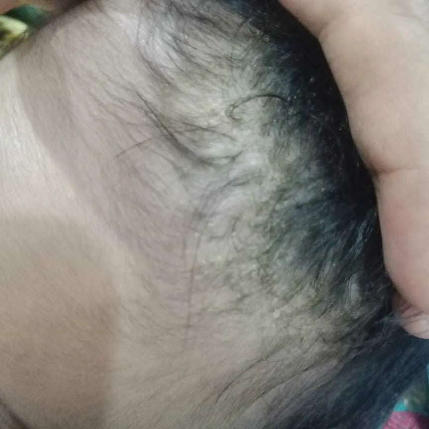 paediatrician Hi sir, my baby is 70 days old. He is having white patches  over his scalp, since 1 week. Its more over front areas of scalp associated  with more hair fall.