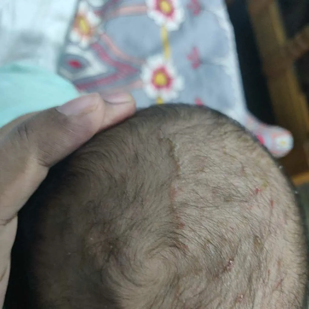 My baby boy, 4 months old has atopy eczema. A doctor prescribed flutivate  ointment on mobile which worked partially but he has recently got infection  at his scalp and face , due